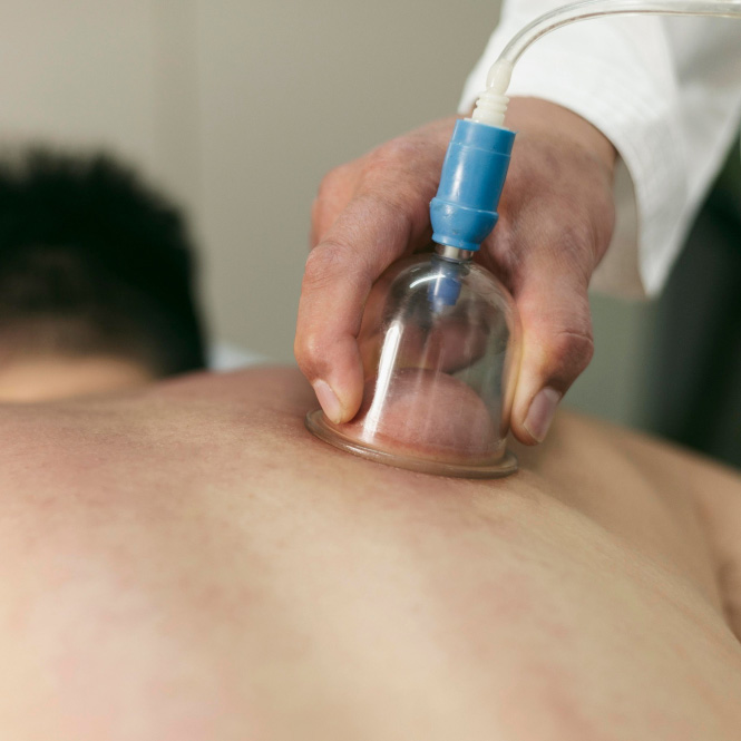 Cupping Therapy Treatment